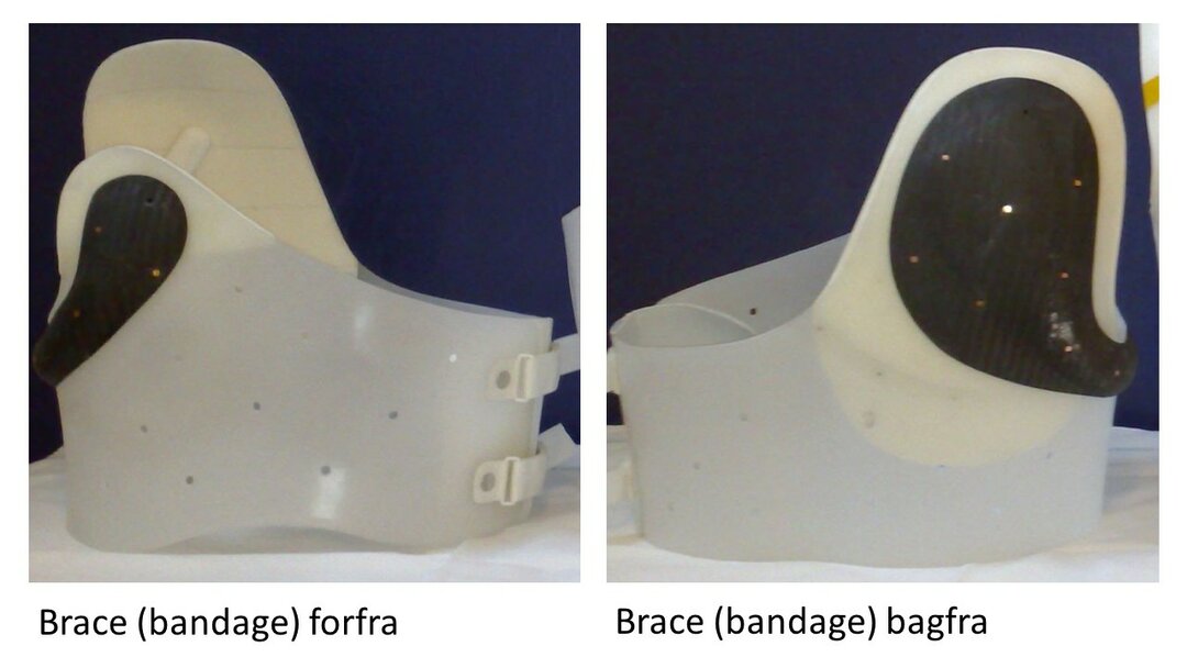 Englevinge (Scapula Alata)